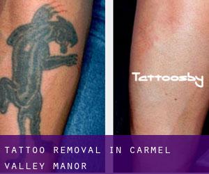 Tattoo Removal in Carmel Valley Manor