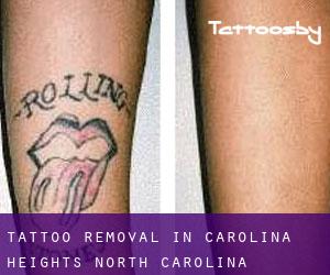 Tattoo Removal in Carolina Heights (North Carolina)