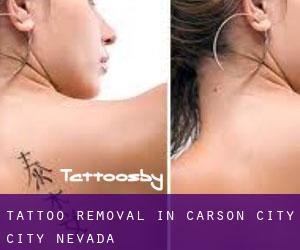 Tattoo Removal in Carson City (City) (Nevada)