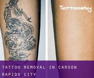 Tattoo Removal in Carson Rapids City
