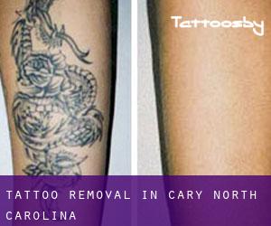 Tattoo Removal in Cary (North Carolina)