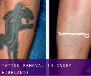 Tattoo Removal in Casey Highlands