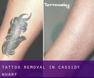 Tattoo Removal in Cassidy Wharf
