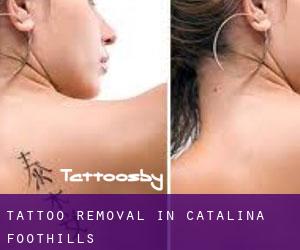 Tattoo Removal in Catalina Foothills