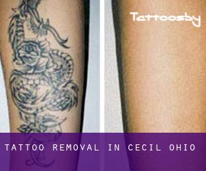 Tattoo Removal in Cecil (Ohio)