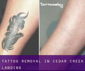 Tattoo Removal in Cedar Creek Landing