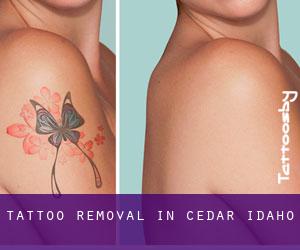 Tattoo Removal in Cedar (Idaho)