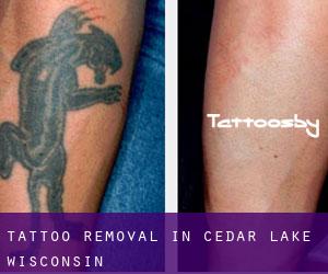 Tattoo Removal in Cedar Lake (Wisconsin)