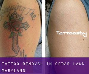 Tattoo Removal in Cedar Lawn (Maryland)