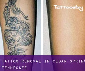 Tattoo Removal in Cedar Spring (Tennessee)