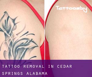Tattoo Removal in Cedar Springs (Alabama)