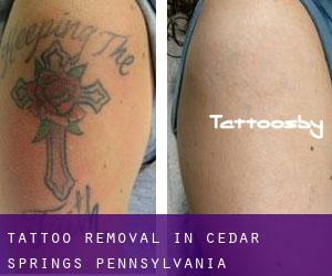 Tattoo Removal in Cedar Springs (Pennsylvania)