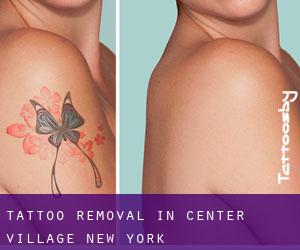 Tattoo Removal in Center Village (New York)
