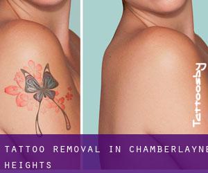 Tattoo Removal in Chamberlayne Heights