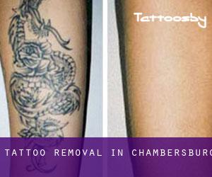 Tattoo Removal in Chambersburg