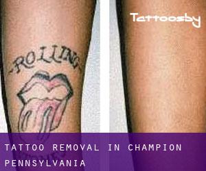 Tattoo Removal in Champion (Pennsylvania)