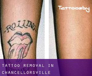 Tattoo Removal in Chancellorsville