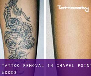 Tattoo Removal in Chapel Point Woods