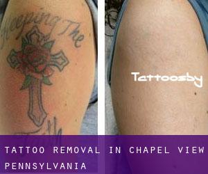 Tattoo Removal in Chapel View (Pennsylvania)