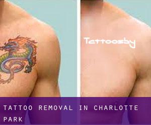 Tattoo Removal in Charlotte Park
