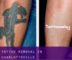 Tattoo Removal in Charlottsville