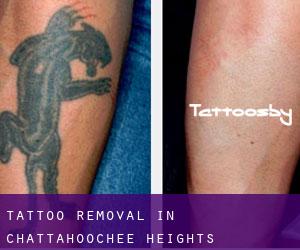 Tattoo Removal in Chattahoochee Heights