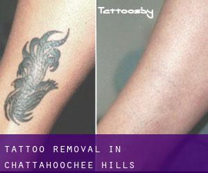 Tattoo Removal in Chattahoochee Hills