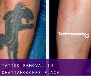 Tattoo Removal in Chattahoochee Place