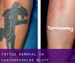 Tattoo Removal in Chat'u'washa'lqs Bluff