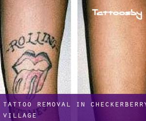 Tattoo Removal in Checkerberry Village