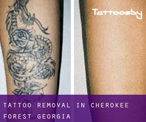 Tattoo Removal in Cherokee Forest (Georgia)