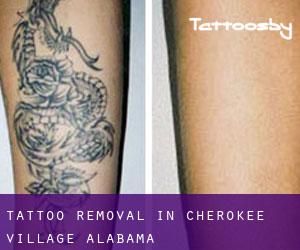 Tattoo Removal in Cherokee Village (Alabama)