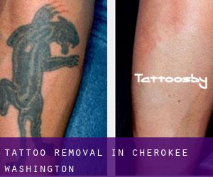 Tattoo Removal in Cherokee (Washington)
