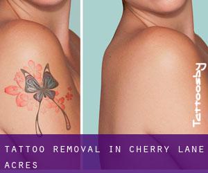 Tattoo Removal in Cherry Lane Acres
