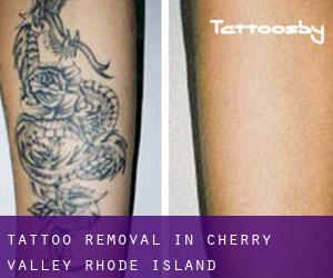 Tattoo Removal in Cherry Valley (Rhode Island)