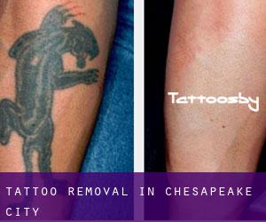 Tattoo Removal in Chesapeake City