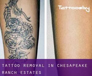 Tattoo Removal in Chesapeake Ranch Estates