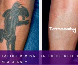 Tattoo Removal in Chesterfield (New Jersey)