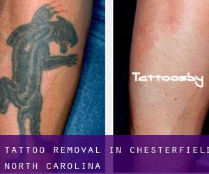 Tattoo Removal in Chesterfield (North Carolina)