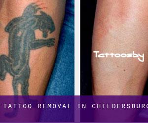 Tattoo Removal in Childersburg
