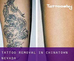 Tattoo Removal in Chinatown (Nevada)