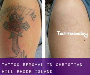 Tattoo Removal in Christian Hill (Rhode Island)