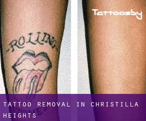 Tattoo Removal in Christilla Heights