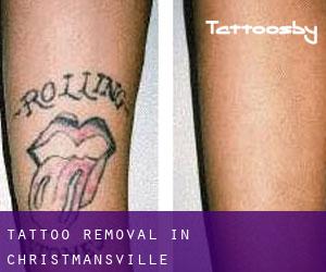 Tattoo Removal in Christmansville