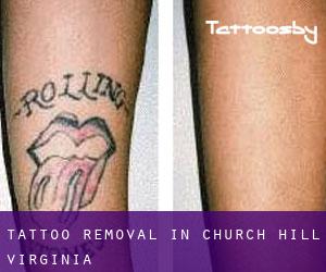 Tattoo Removal in Church Hill (Virginia)