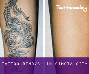 Tattoo Removal in Cimota City