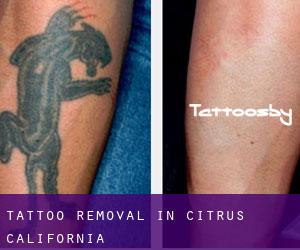 Tattoo Removal in Citrus (California)