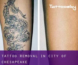 Tattoo Removal in City of Chesapeake