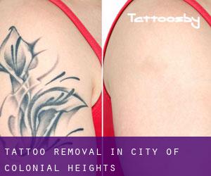 Tattoo Removal in City of Colonial Heights