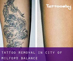Tattoo Removal in City of Milford (balance)
